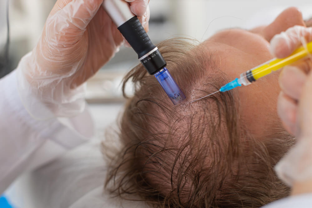 Mesotherapy Mesotherapy