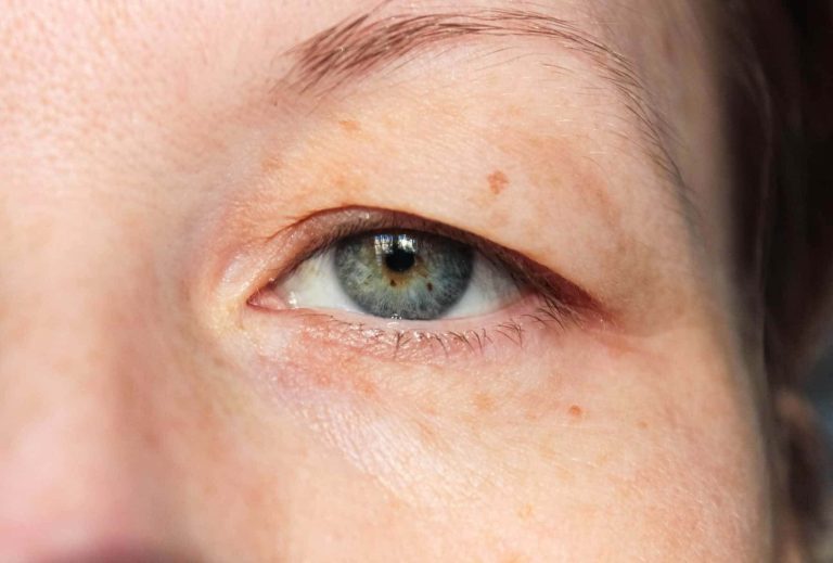 Dropped Eyelids
