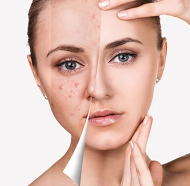 Salicylic acid