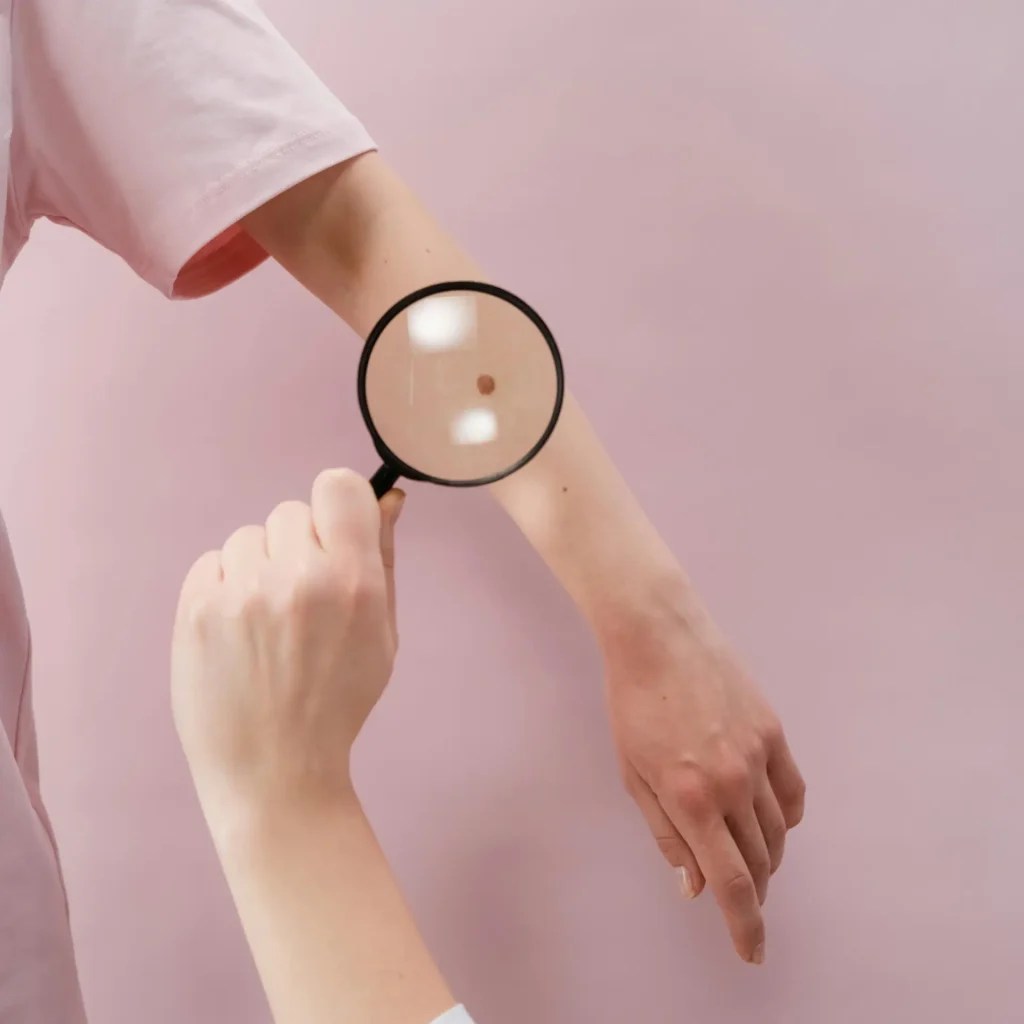 Mole Removal Mole Removal