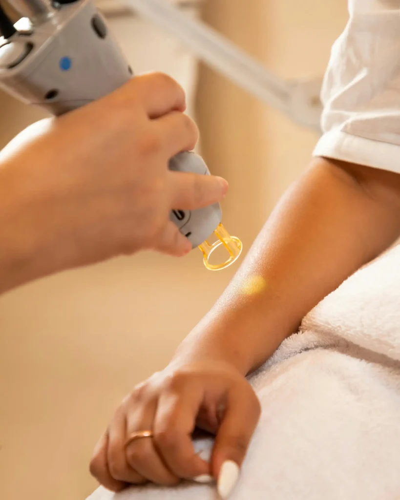 Laser Pigmentation Removal Laser Pigmentation Removal