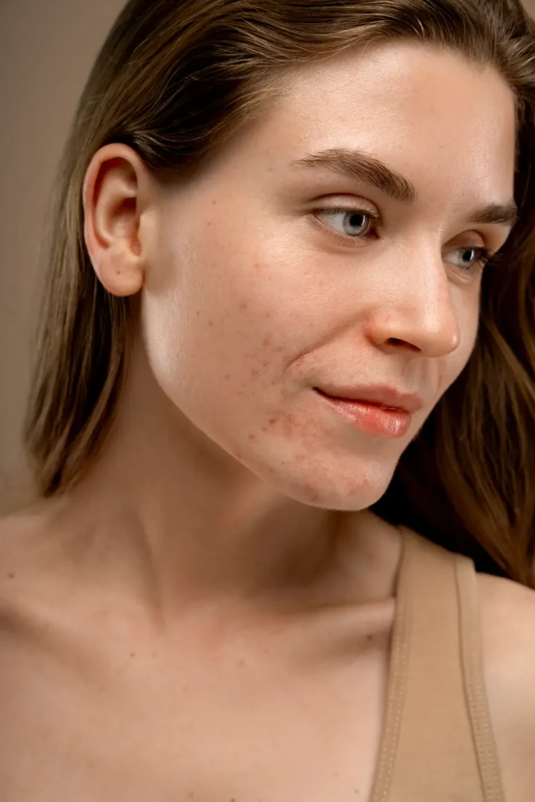 Acne Scars
