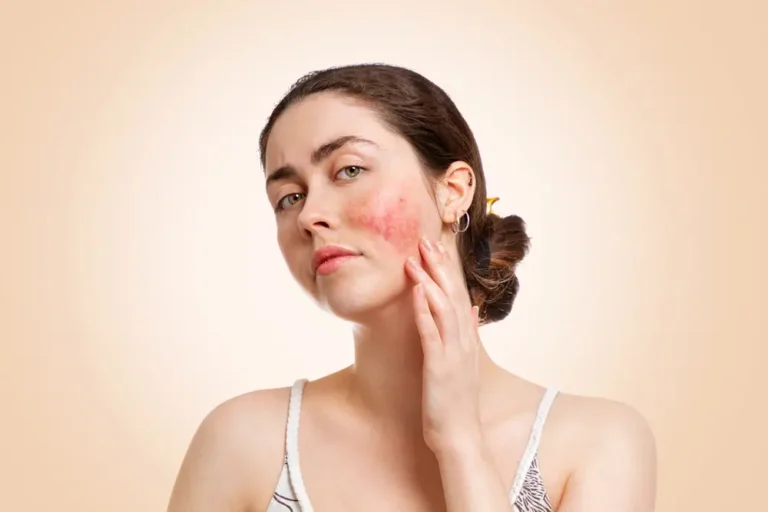 Rosacea