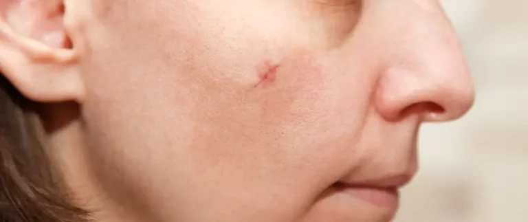 Surgical Scars