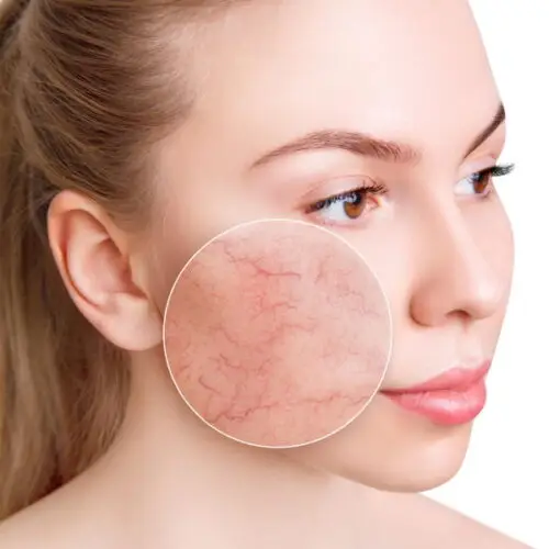 Vascular Lesions