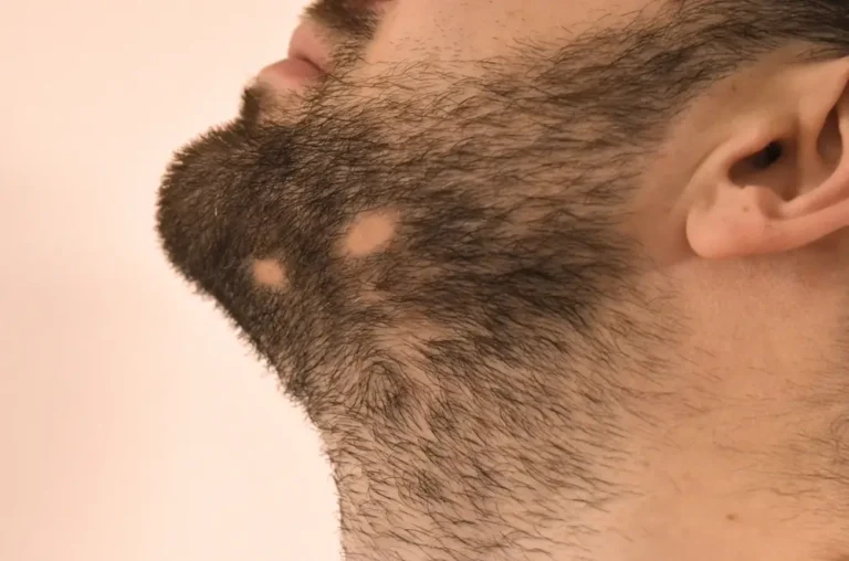 Alopecia