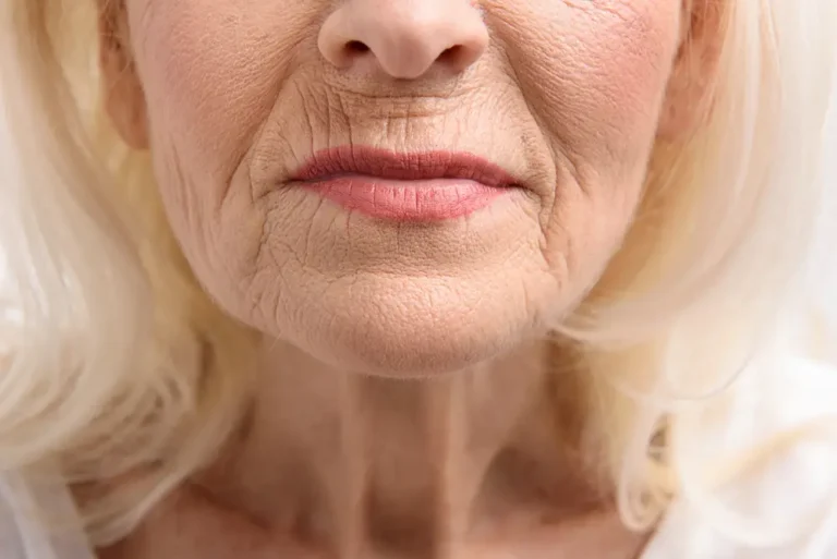 Wrinkles