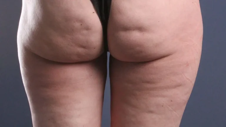 Buttocks Dimples