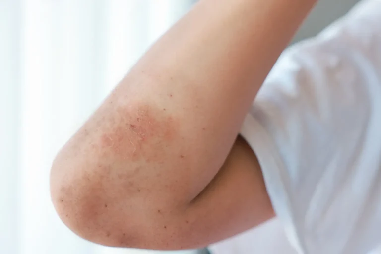 Elbows Pigmentation