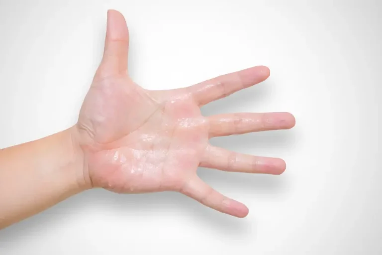 Excessive Sweating
