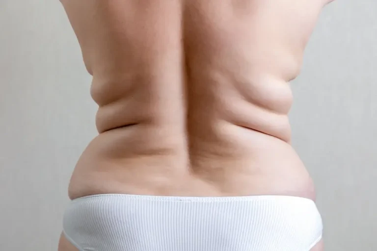 Saggy Skin