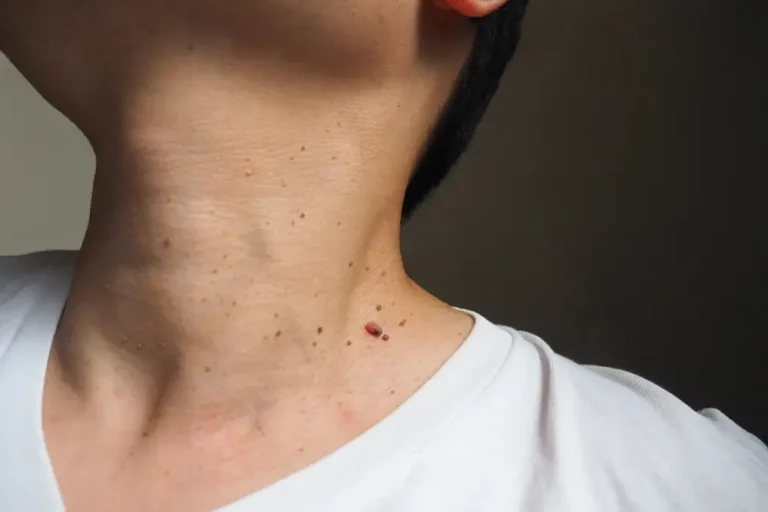 Skin Tag Removal