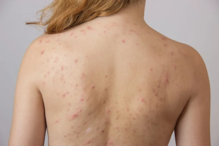 Acne