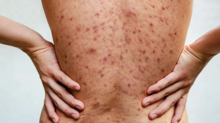 Acne Scars